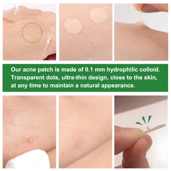 ELAIMEI Acne Pimple Removal Patch Remover Facial Care Spot Blemish Skin Tool Sticker 24