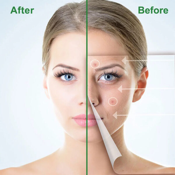 ELAIMEI Acne Pimple Removal Patch Remover Facial Care Spot Blemish Skin Tool Sticker 24