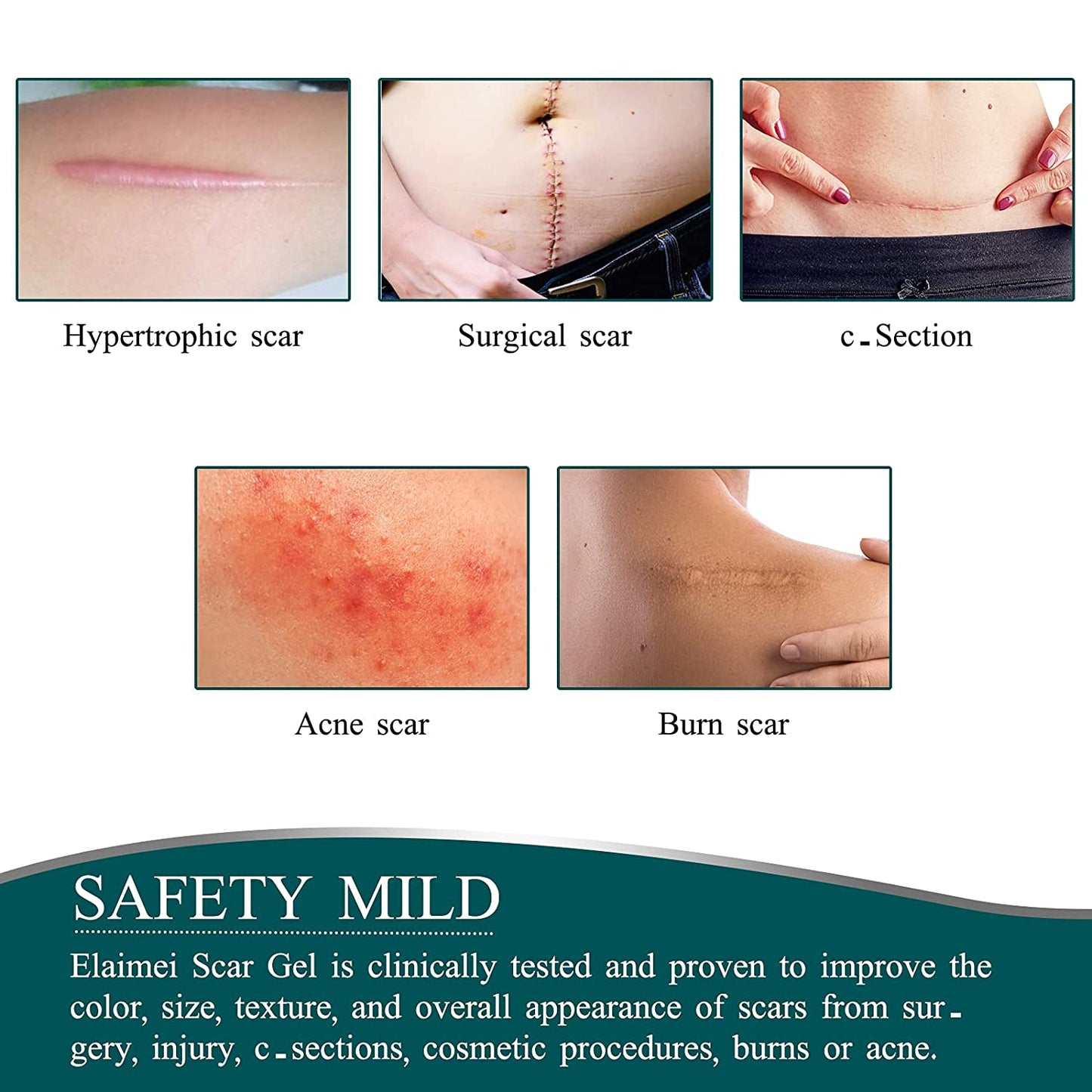 Elaimei Silicone Gel Sheet Patch Scar Removal Wound Skin Repair Treatment Remover Keloid Surgery - 3M Long